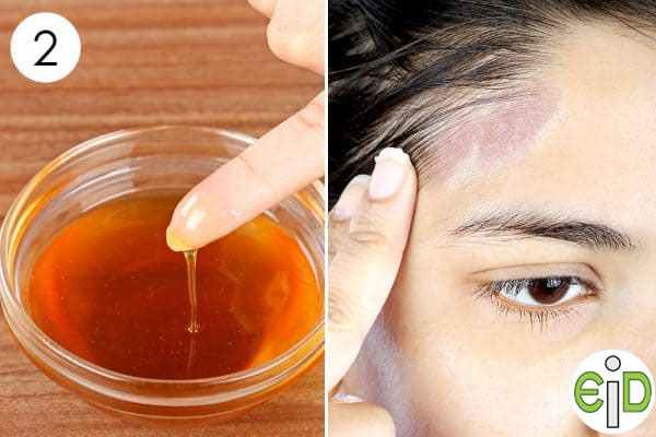 2. adım seboreik dermatitten kurtulmak için etkilenen cilde uygulayın